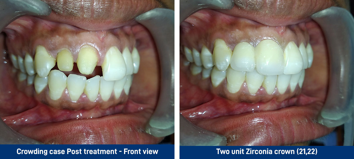 Non vital teeth