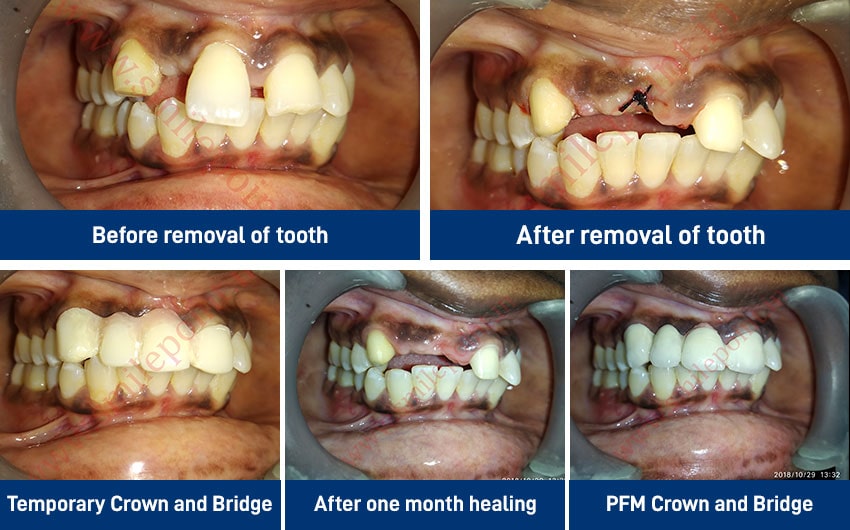 Ceramic & Zirconia