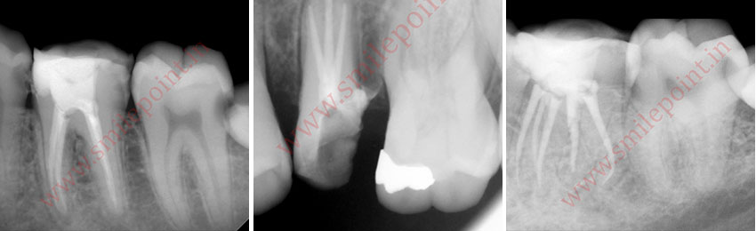 Root Canal Treatment