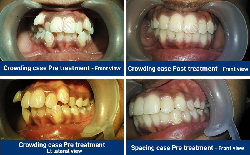 Teeth Alignment